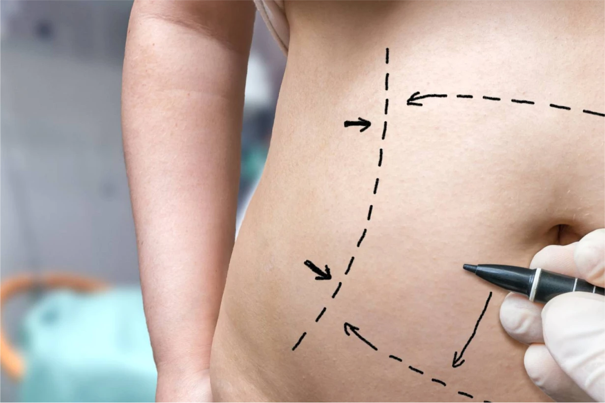 Le système Rénuvion