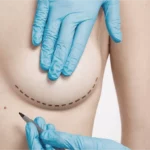 Docteur Maxime Cowen Chirurgien Esthetique Marseille LES RISQUES DE LINTERVENTION