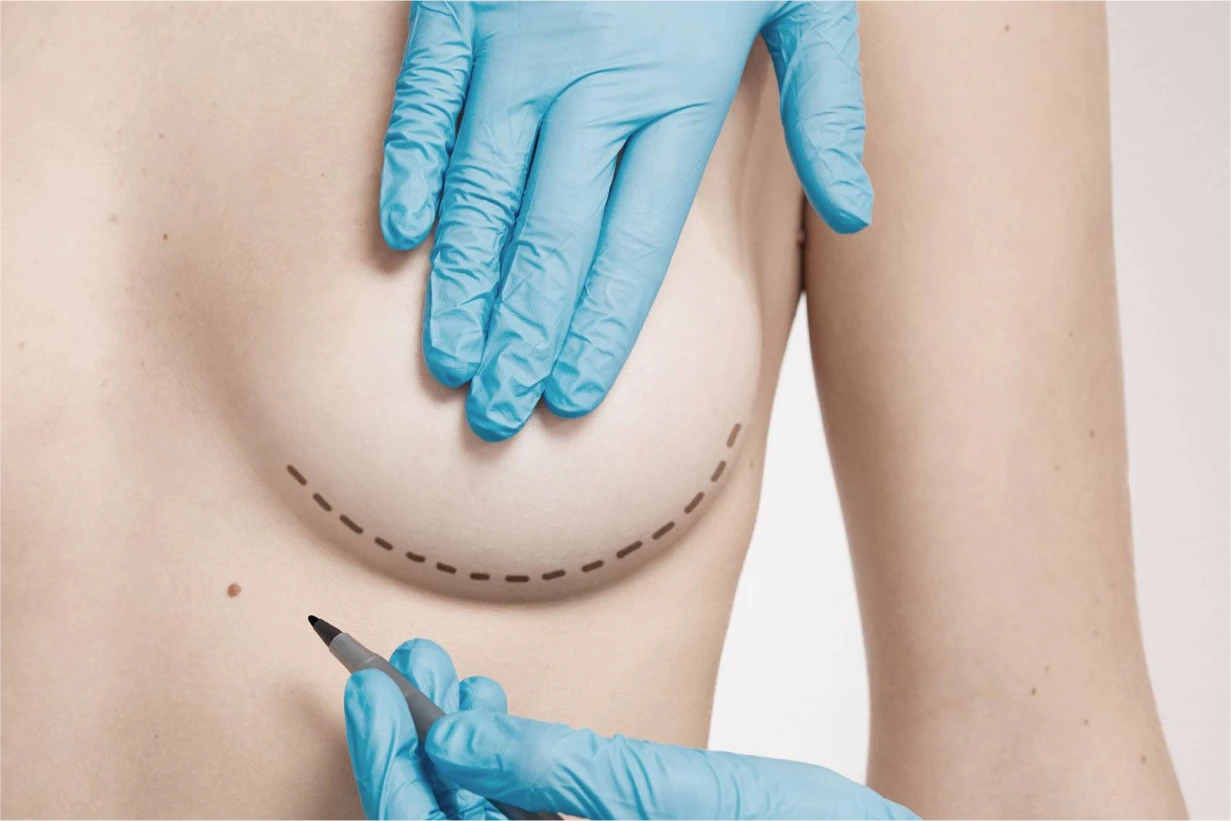 Chirurgie de Reconstruction Mammaire