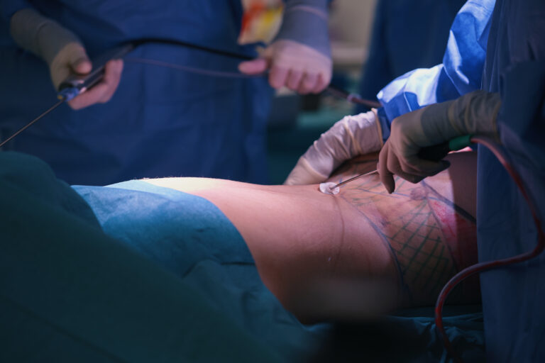 High Definition Liposuction In The Operating Room